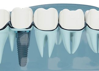 De ce este necesar tratamentul cu implanturi dentare?