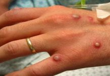 Persoanele născute înainte de 1979 sunt vaccinate împotriva variolei și au un risc mai mic de infectare cu variola maimuței