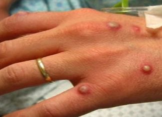 Persoanele născute înainte de 1979 sunt vaccinate împotriva variolei și au un risc mai mic de infectare cu variola maimuței