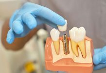 De ce ar trebui să alegeți un implant dentar