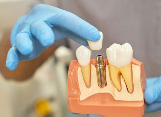 De ce ar trebui să alegeți un implant dentar