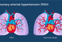 Spitalul Victor Babeș Timișoara, singurul Centru Expert din vestul țării pentru diagnosticarea și tratarea pacienților cu Hipertensiune Arterială Pulmonară